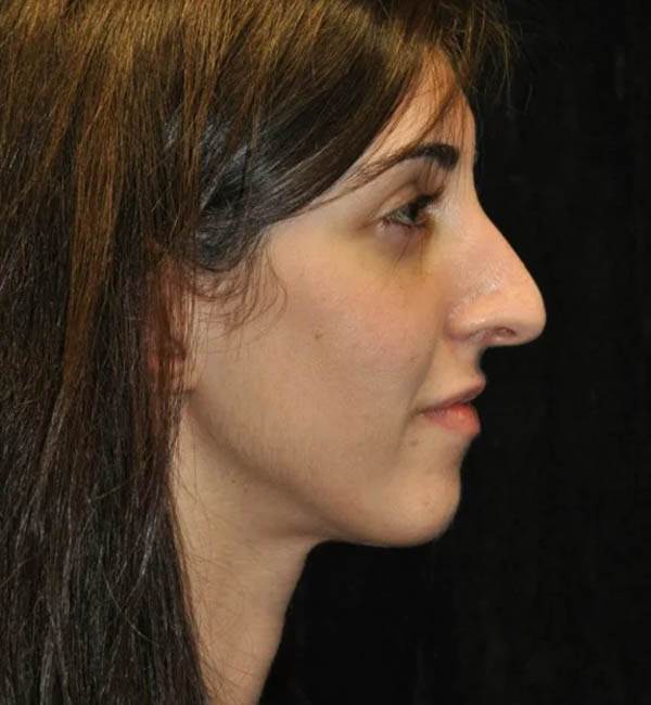 _0294_case-93-rhinoplasty-view-1-1.webp