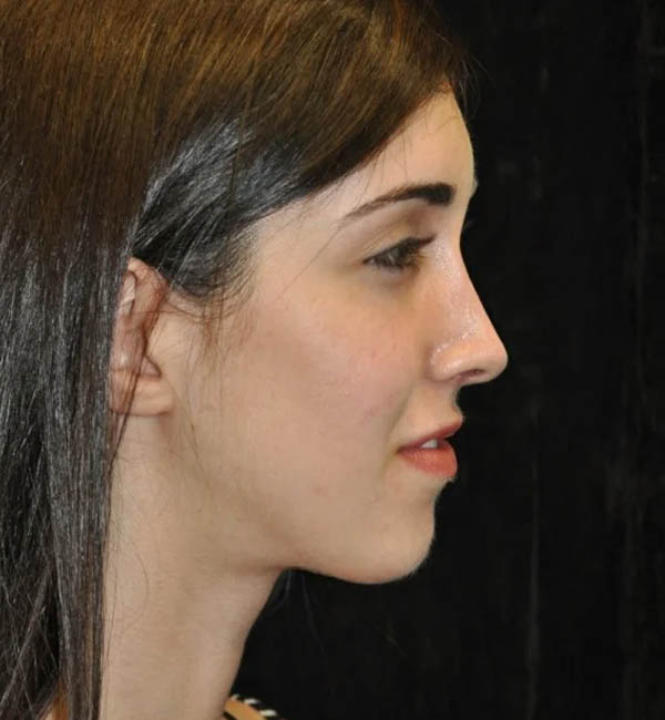 _0295_case-93-rhinoplasty-view-1-2.webp