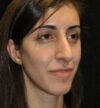 Rhinoplasty case #13295