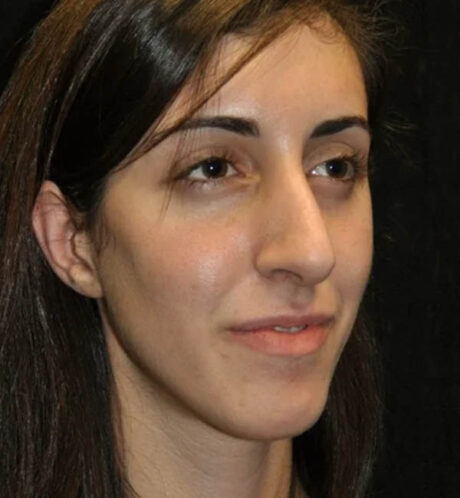 Rhinoplasty case #13295