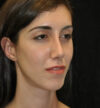 Rhinoplasty case #13295