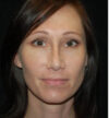 Rhinoplasty case #13300