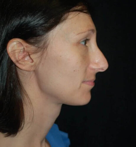 Rhinoplasty case #13300