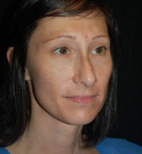 Rhinoplasty case #13300