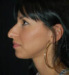 Rhinoplasty case #13307