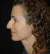 Rhinoplasty case #13312