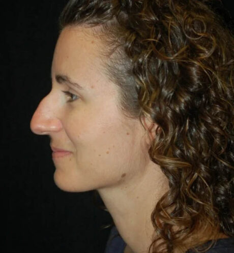 Rhinoplasty case #13312