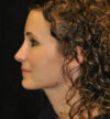 Rhinoplasty case #13312