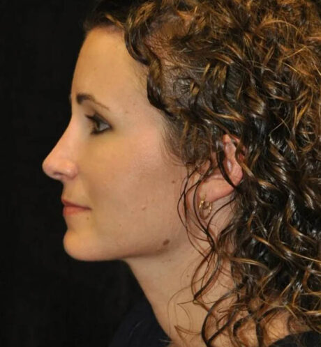 Rhinoplasty case #13312