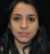 Rhinoplasty case #13317