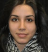Rhinoplasty case #13317