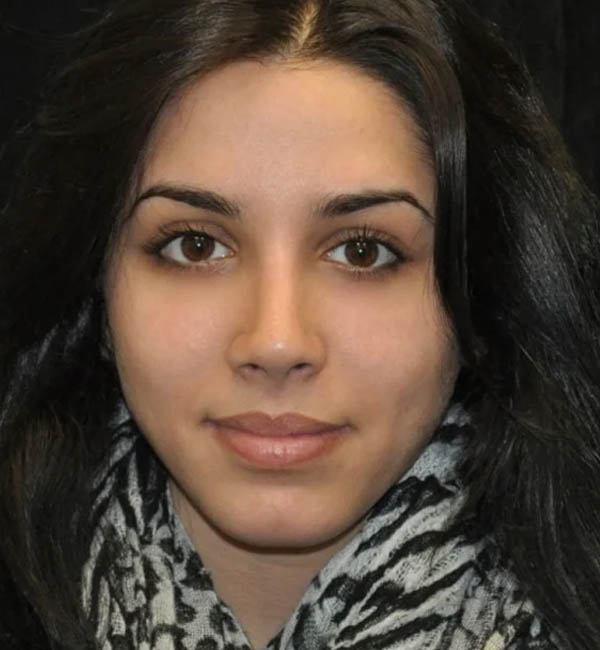 Rhinoplasty case #13317