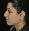 Rhinoplasty case #13317
