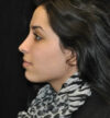 Rhinoplasty case #13317