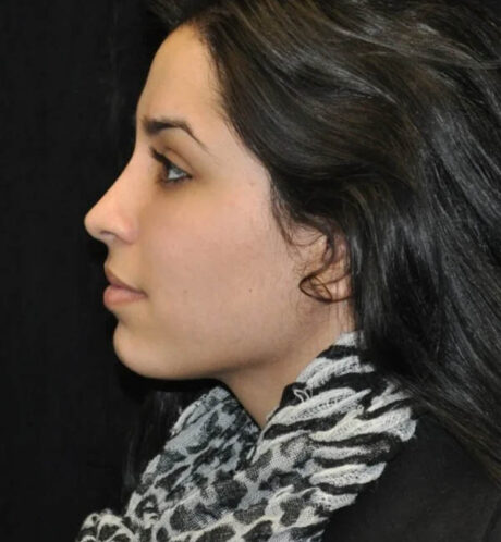 Rhinoplasty case #13317