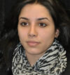 Rhinoplasty case #13317