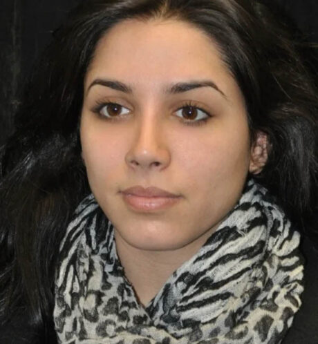 Rhinoplasty case #13317