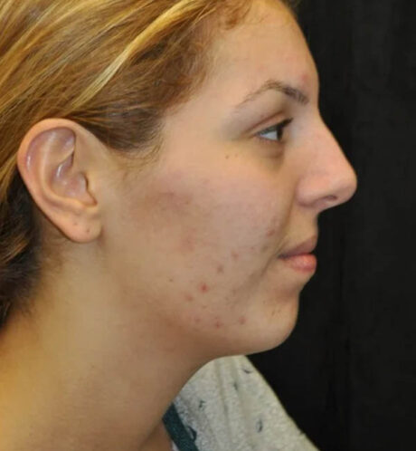 Rhinoplasty case #13324