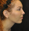 Rhinoplasty case #13324