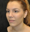 Rhinoplasty case #13324