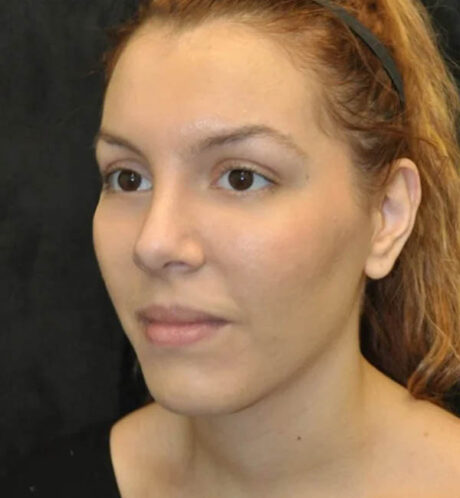 Rhinoplasty case #13324