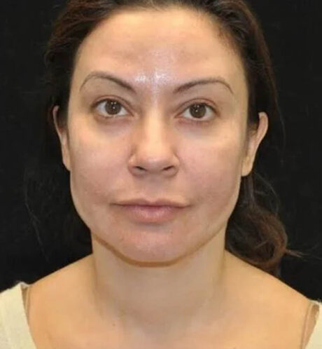 Rhinoplasty case #13329
