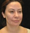 Rhinoplasty case #13329