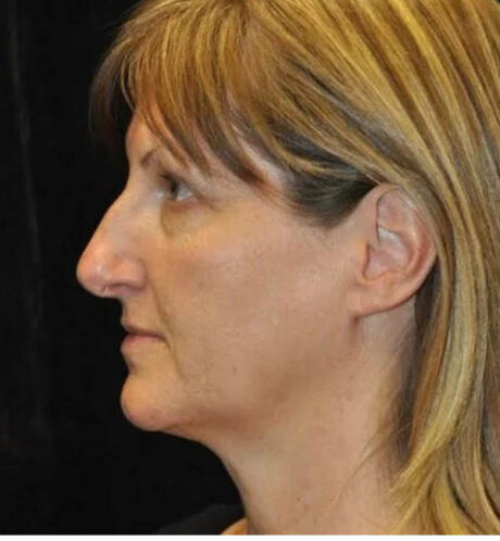 Rhinoplasty case #13339
