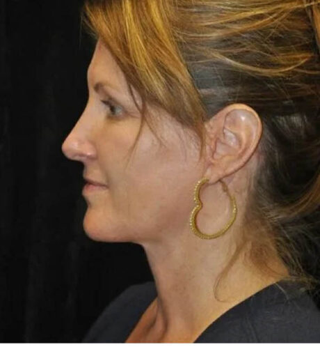 Rhinoplasty case #13339