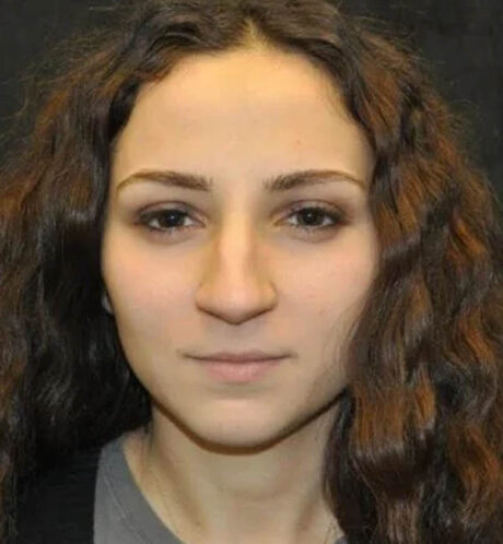 Rhinoplasty case #13345