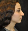 Rhinoplasty case #13345