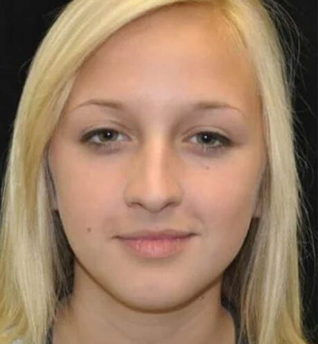 Rhinoplasty case #13359