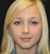 Rhinoplasty case #13359