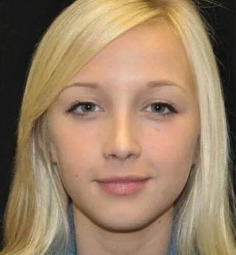 Rhinoplasty case #13359