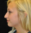 Rhinoplasty case #13359