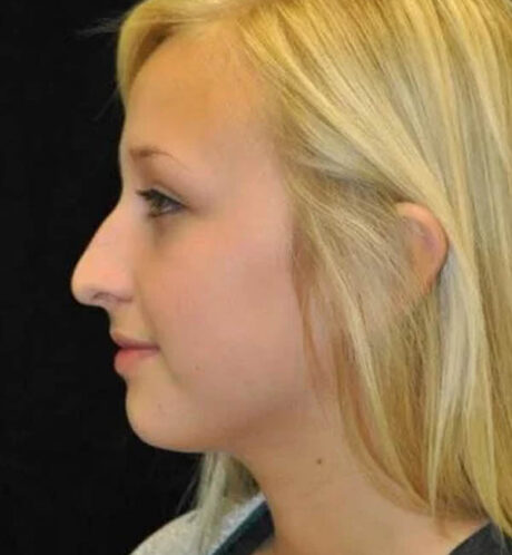 Rhinoplasty case #13359