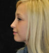 Rhinoplasty case #13359