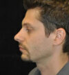 Rhinoplasty case #13366