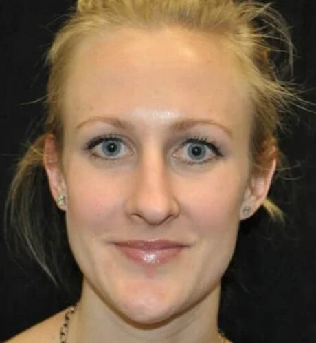 Rhinoplasty case #13373