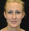 Rhinoplasty case #13373