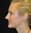 Rhinoplasty case #13373