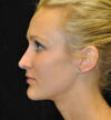 Rhinoplasty case #13373