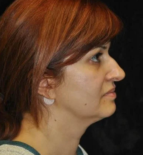 _0368_case-110-rhinoplasty-view-3-1.webp
