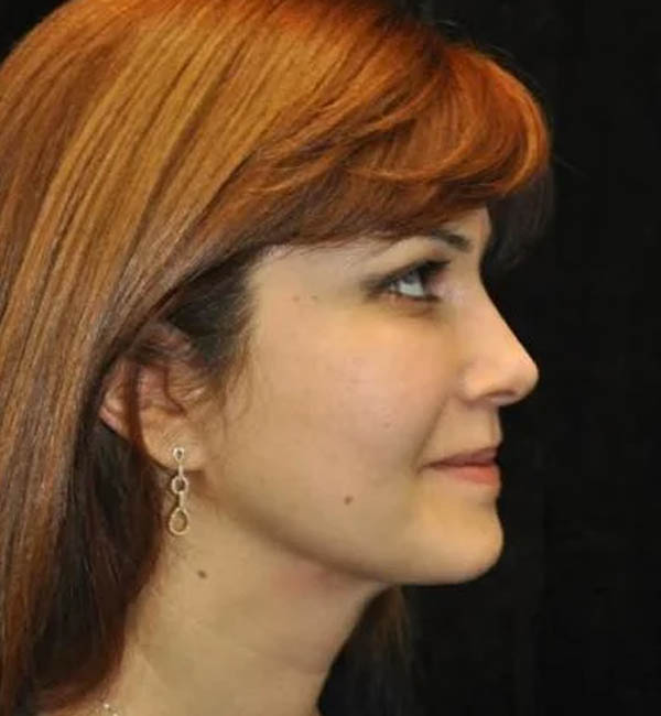 _0369_case-110-rhinoplasty-view-3-2.webp