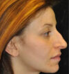 Rhinoplasty case #12744