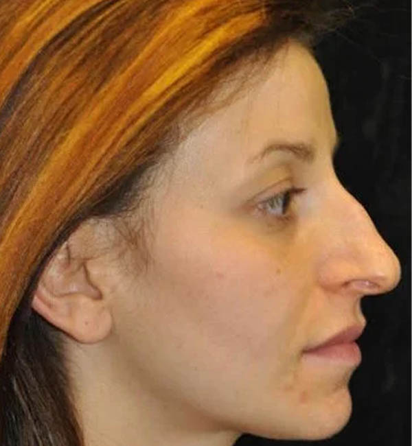Rhinoplasty case #12744