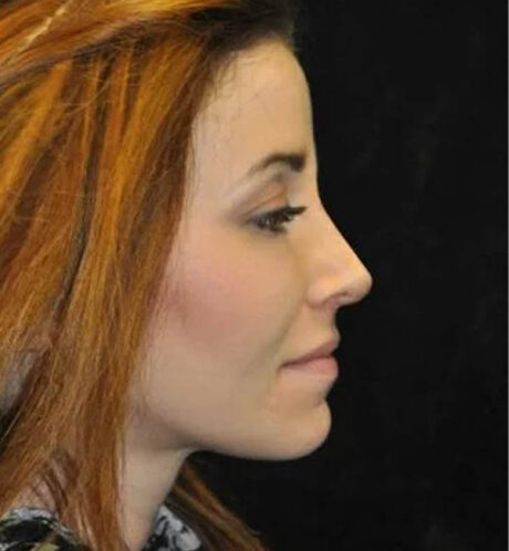 Rhinoplasty case #12744