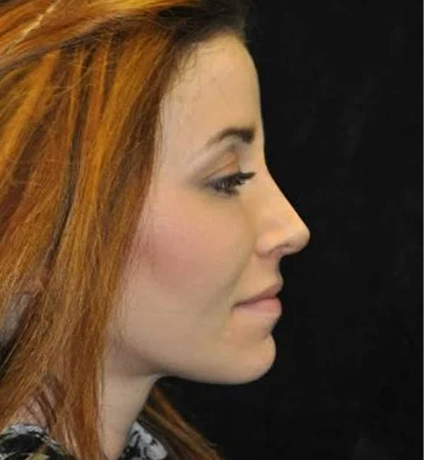 Rhinoplasty case #12744