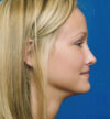 Rhinoplasty case #13103