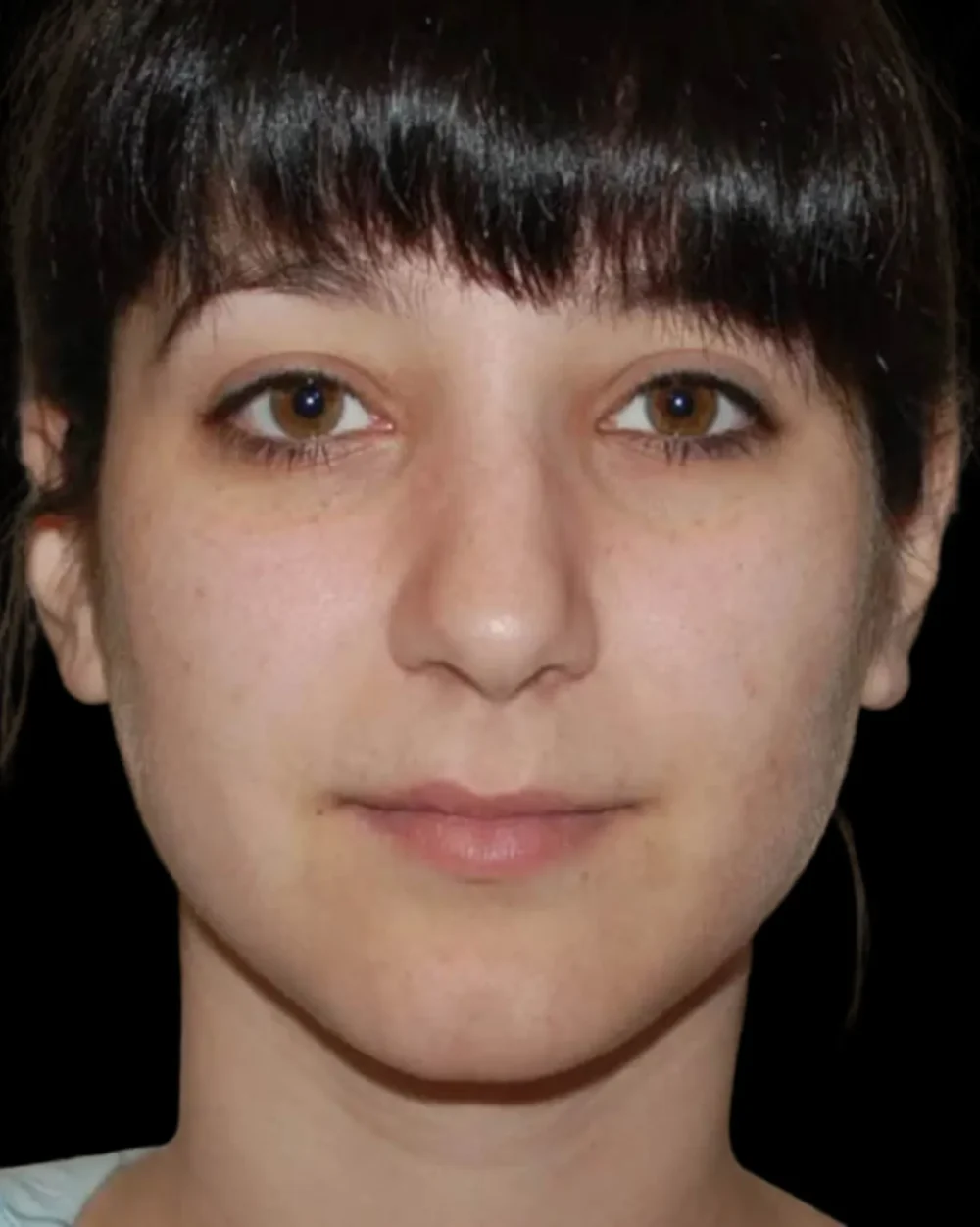 Rhinoplasty case #13272